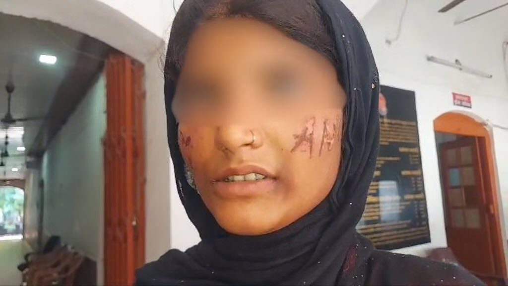 The minor girl, who was raped by Aman Hussain, had his name seared onto her face with a hot iron rod by the accused.